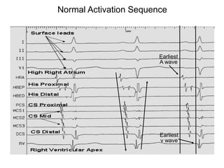 Normal Activation Sequence




                             Earliest
                             A wave




                             Earliest
                             v wave


80
 