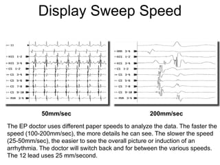 Display Sweep Speed




            50mm/sec                                200mm/sec

The EP doctor uses different paper speeds to analyze the data. The faster the
speed (100-200mm/sec), the more details he can see. The slower the speed
(25-50mm/sec), the easier to see the overall picture or induction of an
arrhythmia. The doctor will switch back and for between the various speeds.
The 12 lead uses 25 mm/second.
 83
 