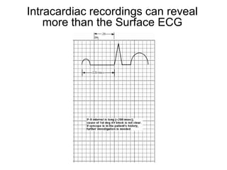 Intracardiac recordings can reveal
         more than the Surface ECG




84
 