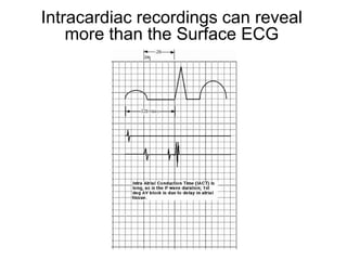 Intracardiac recordings can reveal
         more than the Surface ECG




85
 