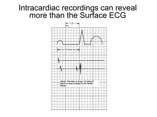 Intracardiac recordings can reveal
         more than the Surface ECG




86
 