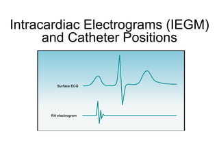Intracardiac Electrograms (IEGM)
      and Catheter Positions




1
 