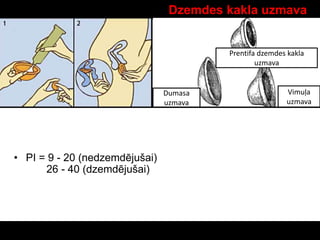 Dzemdes kakla uzmava
• PI = 9 - 20 (nedzemdējušai)
26 - 40 (dzemdējušai)
Dumasa
uzmava
Vimuļa
uzmava
Prentifa dzemdes kakla
uzmava
 
