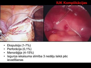 IUK Komplikācijas
• Ekspulsija (1-7%)
• Perforācija (0,1%)
• Menorāģija (4-15%)
• Iegurņa iekaisuma slimība 3 nedēļu laikā pēc
ievadīšanas
 