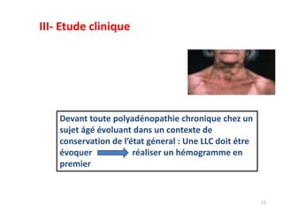 Devant toute polyadénopathie chronique chez un
sujet ágé évoluant dans un contexte de
conservation de l’état géneral : Une LLC doit étre
évoquer réaliser un hémogramme en
premier
12
III- Etude clinique
 