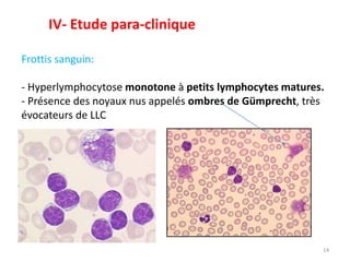Frottis sanguin:
- Hyperlymphocytose monotone à petits lymphocytes matures.
- Présence des noyaux nus appelés ombres de Gümprecht, très
évocateurs de LLC
14
IV- Etude para-clinique
 