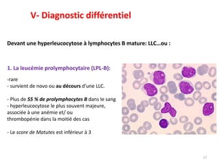 17
1. La leucémie prolymphocytaire (LPL-B):
-rare
- survient de novo ou au décours d'une LLC.
- Plus de 55 % de prolymphocytes B dans le sang
- hyperleucocytose le plus souvent majeure,
associée à une anémie et/ ou
thrombopénie dans la moitié des cas
- Le score de Matutes est inférieur à 3
V- Diagnostic différentiel
Devant une hyperleucocytose à lymphocytes B mature: LLC…ou :
 