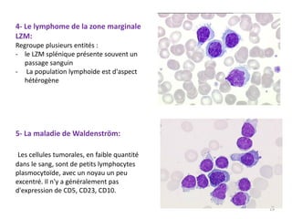 19
4- Le lymphome de la zone marginale
LZM:
Regroupe plusieurs entités :
- le LZM splénique présente souvent un
passage sanguin
- La population lymphoïde est d'aspect
hétérogène
5- La maladie de Waldenström:
Les cellules tumorales, en faible quantité
dans le sang, sont de petits lymphocytes
plasmocytoïde, avec un noyau un peu
excentré. Il n'y a généralement pas
d'expression de CD5, CD23, CD10.
 