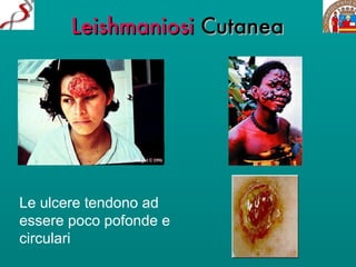 Leishmaniosi  Cutanea Le ulcere tendono ad essere poco pofonde e  circulari 