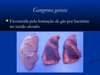 Gangrena gasosa
 Favorecida pela formação de gás por bactérias
no tecido afetado
 