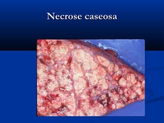 Necrose caseosaNecrose caseosa
 