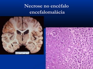 Necrose no encéfalo
encefalomalácia
 