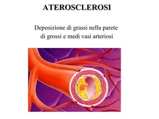 ATEROSCLEROSIATEROSCLEROSI
Deposizione di grassi nella parete
di grossi e medi vasi arteriosi
 