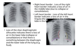 Comprehensive Radiological Diagnosis of Lung Diseases Using Chest X-Ray ...