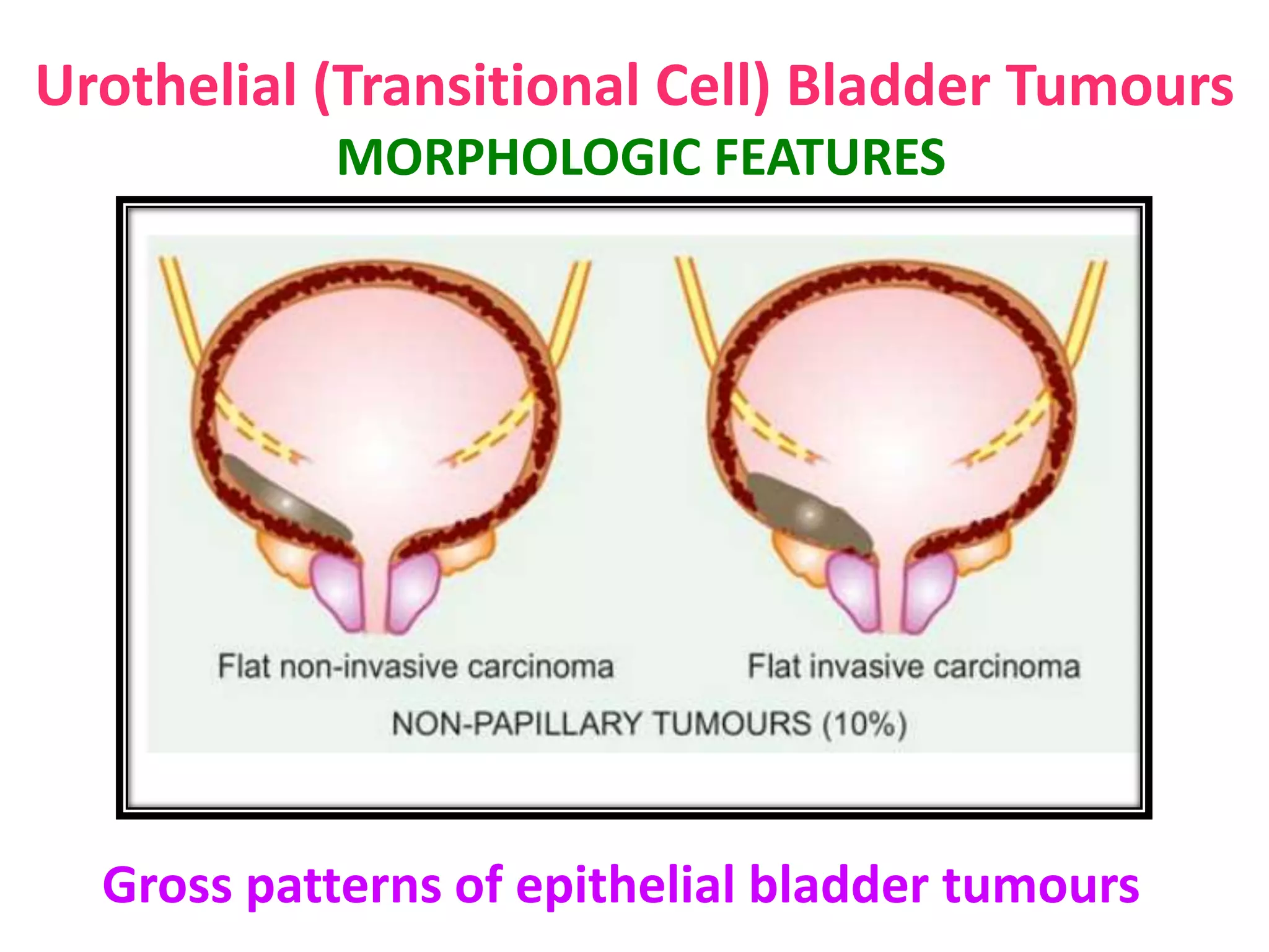RENAL CELL CARCINOMA, Urothelial (Transitional Cell) Bladder Tumours | PPTX