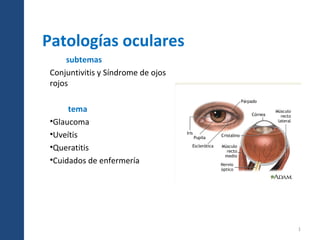Patologías oculares
subtemas
Conjuntivitis y Síndrome de ojos
rojos
tema
•Glaucoma
•Uveítis
•Queratitis
•Cuidados de enfermería
1
 