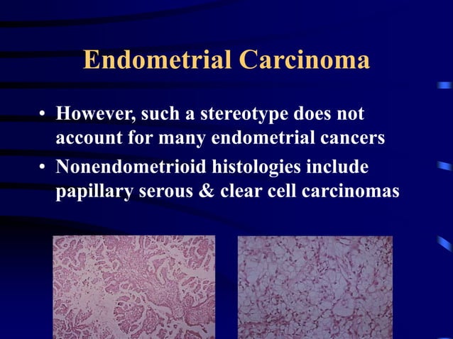 2-medical treatment of endometrial hyperplasia and endometrial cancer | PPT