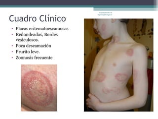 Departamento de



Cuadro Clínico
                              Agentes Biológicos




• Placas eritematoescamosas
• Redondeadas, Bordes
  vesiculosos.
• Poca descamación
• Prurito leve.
• Zoonosis frecuente
 