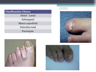 Departamento de
                               Agentes Biológicos

Clasificación Clínica
            Distal - Lateal
             Subungueal
          Blanca superficial
            Distrofica total
             Paroniquia
 