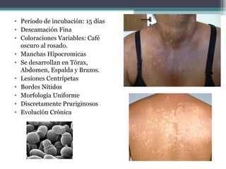 Departamento de
• Periodo de incubación: 15 días   Agentes Biológicos


• Descamación Fina
• Coloraciones Variables: Café
  oscuro al rosado.
• Manchas Hipocromicas
• Se desarrollan en Tórax,
  Abdomen, Espalda y Brazos.
• Lesiones Centrípetas
• Bordes Nítidos
• Morfología Uniforme
• Discretamente Pruriginosos
• Evolución Crónica
 