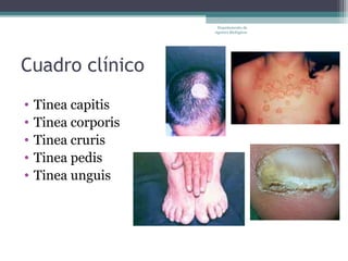 Departamento de
                     Agentes Biológicos




Cuadro clínico
•   Tinea capitis
•   Tinea corporis
•   Tinea cruris
•   Tinea pedis
•   Tinea unguis
 