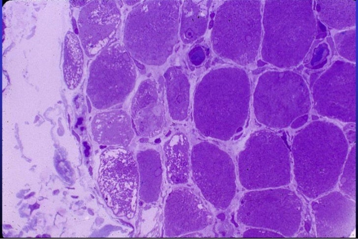 2. miopatia inflamatoria dr grau