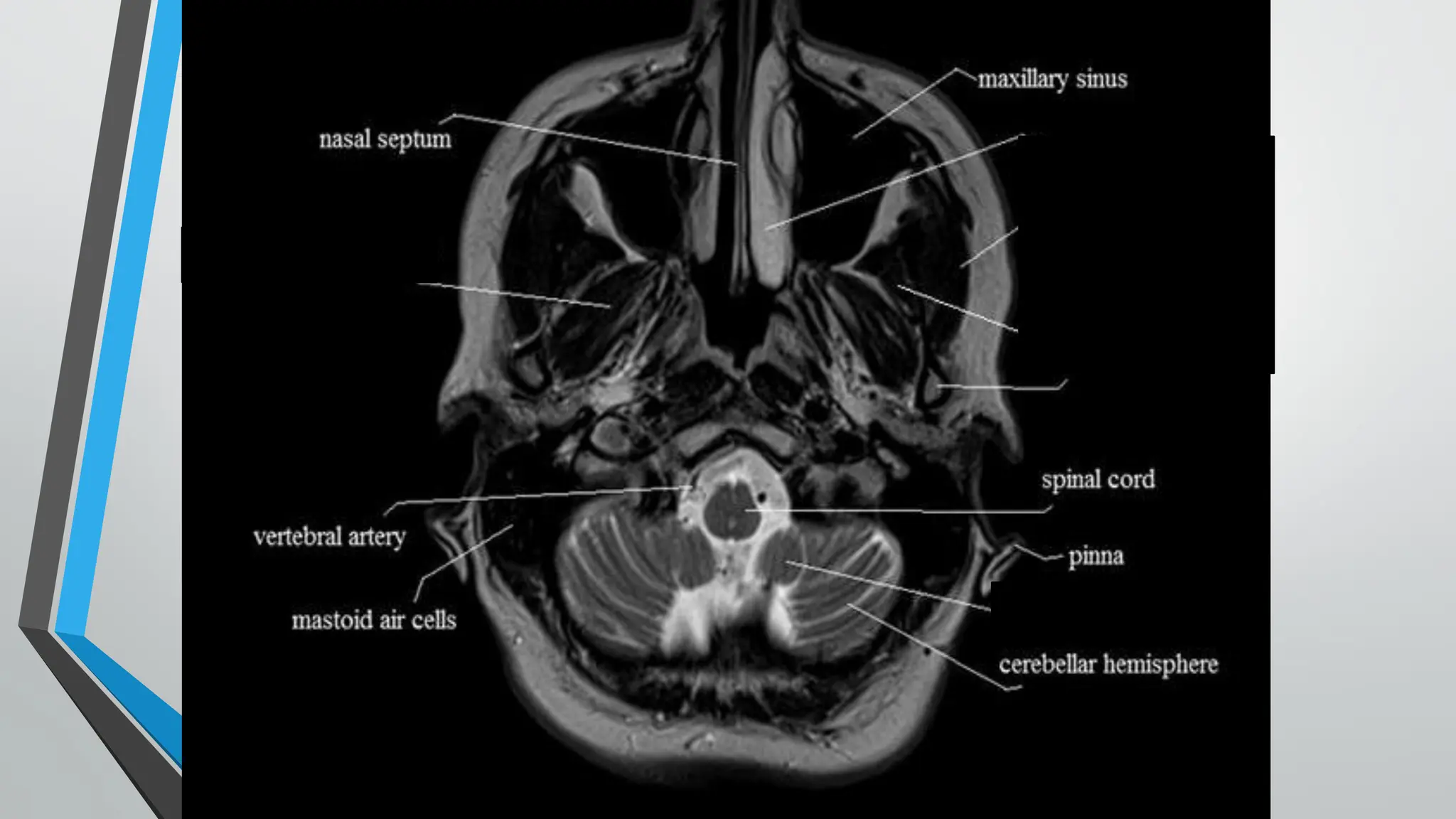 MRI Anatomy RMI 317 Brain Anatomy Biology Diagrams