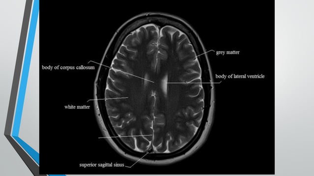 2- MRI Anatomy RMI 317 Brain Anatomy - Part 1 .pdf