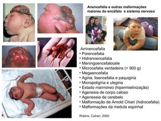 Arrinencefalia Porencefalia Hidrannencefalia Meningoencefalocele Microcefalia verdadeira (< 900 g) Megaencefalia Agiria, lisencefalia e paquigiria Micropoligiria e ulegiria Estado marmóreo (hipermielinização) Agenesia de corpo caloso Ageneseia de cerebelo Malformação de Arnold Chiari (hidrocefalia) Malformações da medula espinhal Robins; Cotran, 2000 Anencefalia e outras maformações  maiores do encéfalo  e sistema nervoso 