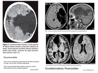 Esquizencefalia Tipo I que se caracteriza pela presença de lábios fechados, ou seja, com as duas corticais justapostas;  Tipo II que apresenta lábios abertos, estando a fenda preenchida por líquido cefalorraquidiano.  Amaral, 2001  Encefalomalácia; Porencefalia Low, Cristiane et al.  