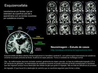 Esquizencefalia Esquizencefalia de lábios abertos (fenda longitudinal no hemisfério cerebral) E, com polimicrogiria heterotopias de substância cinzenta na porção profunda da fenda. Ausência do septo pelúcido. Tronco e cerebelo de morfologia normal.  Obs:  As malformações decorrem de lesão cerebral, geralmente de origem vascular, na fase de proliferação/migração (13ª a 24ª semanas de gestação). As heterotopias de substância cinzenta na porção profunda da fenda correspondem a neurônios que não migraram porque houve destruição das células da glia que guiam a migração. Não se trata de deficiência do processo de migração. O que houve foi a destruição do caminho que os neurônios seguiriam para formar o córtex.   Neuroimagem – Estudo de casos http://anatpat.unicamp.br/rpgneominis.html   caracteriza-se por fendas, que se estendem da superfície pial até a ependimária com as bordas revestidas por substância cinzenta.  