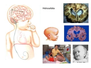 Hidrocefalia 
