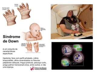 é um conjunto de características específicas: hipotonia, face com perfil achatado, crânio braquicéfalo, olhos amendoados ou fissuras palpebrais oblíquas, língua protrusa, pescoço curto, prega palmar transversal única, entre outros; e não uma doença.  Síndrome de Down 
