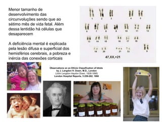 Menor tamanho de desenvolvimento das circunvoluções sendo que ao sétimo mês de vida fetal. Além dessa lentidão há células que desaparecem A deficiência mental é explicada pela lesão difusa e superficial dos hemisférios cerebrais, a pobreza e inércia das conexões corticais  Observations on an Ethnic Classification of Idiots  by J. Langdon H. Down, M.D., London ( John Langdon Haydon Down, 1828-1896 ) London Hospital Reports, 3:259-262, 1866 