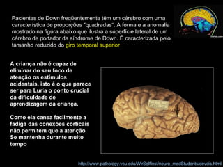 Pacientes de Down freqüentemente têm um cérebro com uma característica de proporções "quadradas“. A forma e a anomalia mostrado na figura abaixo que ilustra a superfície lateral de um cérebro de portador da síndrome de Down. É caracterizada pelo tamanho reduzido do  giro temporal superior   http://www.pathology.vcu.edu/WirSelfInst/neuro_medStudents/devdis.html A criança não é capaz de eliminar do seu foco de atenção os estímulos acidentais, isto é o que parece ser para Luria o ponto crucial da dificuldade de aprendizagem da criança.  Como ela cansa facilmente a fadiga das conexões corticais não permitem que a atenção Se mantenha durante muito tempo  