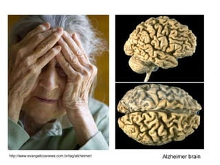 http://www.evangelicosnews.com.br/tag/alzheimer/ Alzheimer brain 