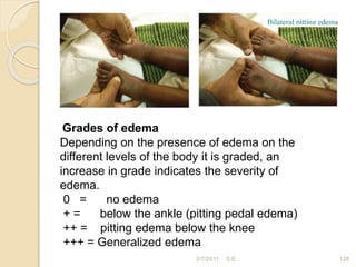 2/7/2011 S.E. 128
Grades of edema
Depending on the presence of edema on the
different levels of the body it is graded, an
increase in grade indicates the severity of
edema.
0 = no edema
+ = below the ankle (pitting pedal edema)
++ = pitting edema below the knee
+++ = Generalized edema
 