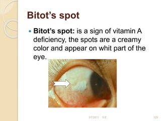 Bitot’s spot
 Bitot’s spot: is a sign of vitamin A
deficiency, the spots are a creamy
color and appear on whit part of the
eye.
2/7/2011 S.E. 129
 