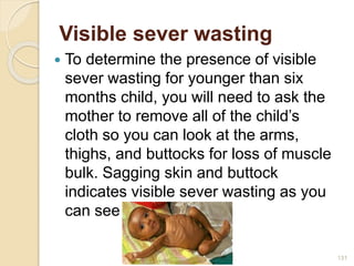 Visible sever wasting
 To determine the presence of visible
sever wasting for younger than six
months child, you will need to ask the
mother to remove all of the child’s
cloth so you can look at the arms,
thighs, and buttocks for loss of muscle
bulk. Sagging skin and buttock
indicates visible sever wasting as you
can see in the figure.
2/7/2011 S.E. 131
 