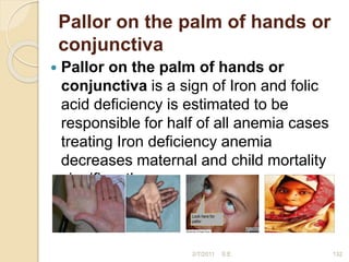 Pallor on the palm of hands or
conjunctiva
 Pallor on the palm of hands or
conjunctiva is a sign of Iron and folic
acid deficiency is estimated to be
responsible for half of all anemia cases
treating Iron deficiency anemia
decreases maternal and child mortality
significantly.
2/7/2011 S.E. 132
 