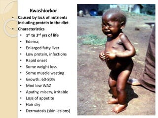 Kwashiorkor
• Caused by lack of nutrients
including protein in the diet
• Characteristics
• 1st to 3rd yrs of life
• Edema;
• Enlarged fatty liver
• Low protein, infections
• Rapid onset
• Some weight loss
• Some muscle wasting
• Growth: 60-80%
• Mod low WAZ
• Apathy, misery, irritable
• Loss of appetite
• Hair dry
• Dermatosis (skin lesions)
2/7/2011 151
S.E.
 