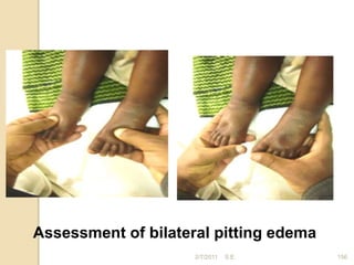2/7/2011 156
Assessment of bilateral pitting edema
S.E.
 