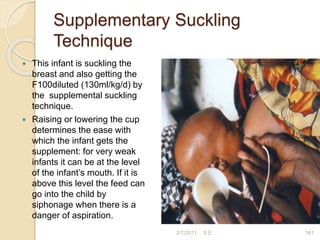 Supplementary Suckling
Technique
 This infant is suckling the
breast and also getting the
F100diluted (130ml/kg/d) by
the supplemental suckling
technique.
 Raising or lowering the cup
determines the ease with
which the infant gets the
supplement: for very weak
infants it can be at the level
of the infant’s mouth. If it is
above this level the feed can
go into the child by
siphonage when there is a
danger of aspiration.
2/7/2011 161
S.E.
 