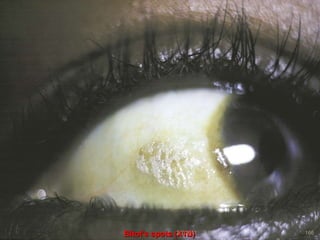 Bitot’s spots (X1B)
2/7/2011 S.E. 166
 