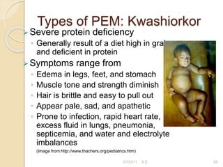 Types of PEM: Kwashiorkor
Severe protein deficiency
◦ Generally result of a diet high in grains
and deficient in protein
Symptoms range from
◦ Edema in legs, feet, and stomach
◦ Muscle tone and strength diminish
◦ Hair is brittle and easy to pull out
◦ Appear pale, sad, and apathetic
◦ Prone to infection, rapid heart rate,
excess fluid in lungs, pneumonia,
septicemia, and water and electrolyte
imbalances
(Image from http://www.thachers.org/pediatrics.htm)
55
2/7/2011 S.E.
 