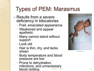 Types of PEM: Marasmus
Results from a severe
deficiency in kilocalories
◦ Frail, emaciated appearance
◦ Weakened and appear
apathetic
◦ Many cannot stand without
support
◦ Look old
◦ Hair is thin, dry, and lacks
sheen
◦ Body temperature and blood
pressure are low
◦ Prone to dehydration,
infections, and unnecessary
blood clotting 56
2/7/2011 S.E.
 