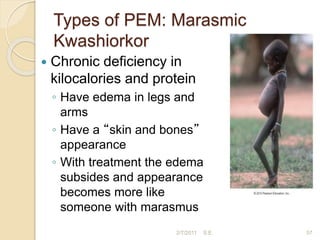 Types of PEM: Marasmic
Kwashiorkor
 Chronic deficiency in
kilocalories and protein
◦ Have edema in legs and
arms
◦ Have a “skin and bones”
appearance
◦ With treatment the edema
subsides and appearance
becomes more like
someone with marasmus
57
2/7/2011 S.E.
 