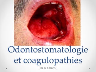 Odontostomatologie
et coagulopathies
Dr A.Chafai
 