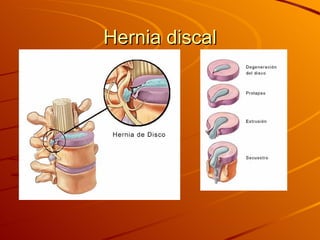 Hernia discal 