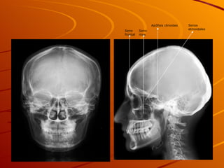 Apófisis clinoides Seno max Seno frontal Senos etmoidales 